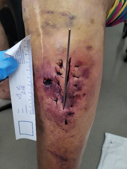 Ausgangssituation Wunde Johanna R